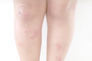 伝染性膿痂疹(とびひ)のイメージ