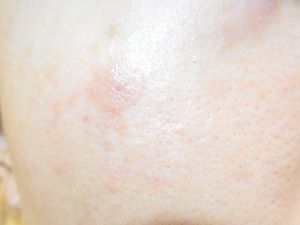 乳児脂漏性皮膚炎のイメージ画像