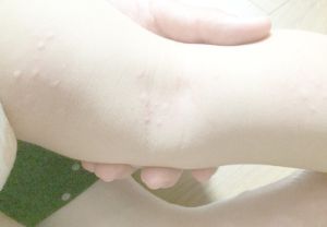 伝染性軟属腫(水いぼ)のイメージ画像