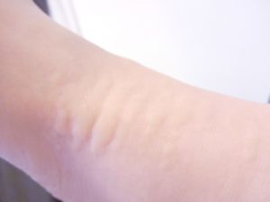 じんま疹のイメージ画像