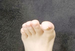 巻き爪のイメージ画像