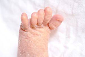 足・爪白癬(水虫・爪水虫)のイメージ画像