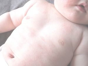 乳児湿疹のイメージ画像
